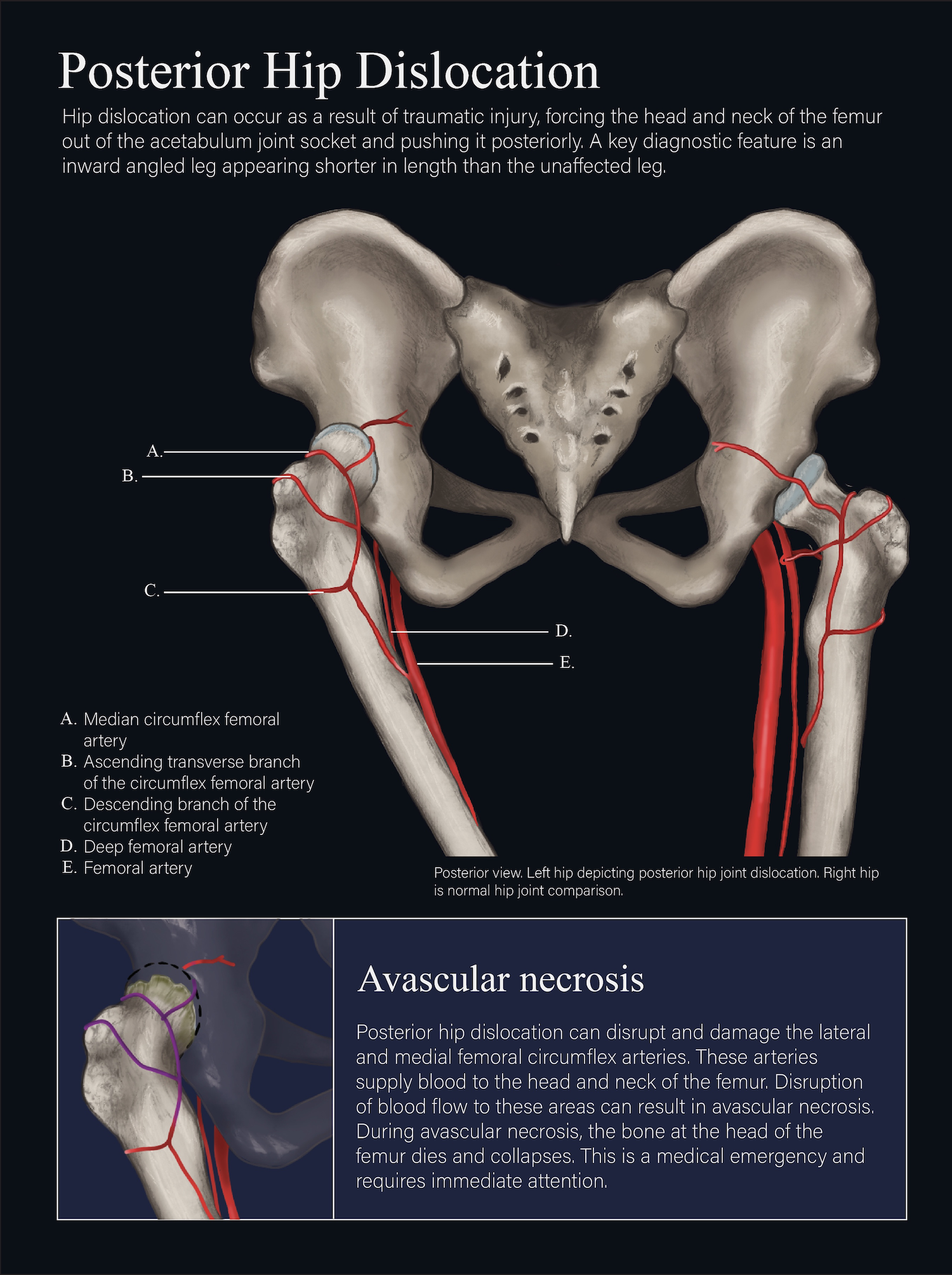 Posterior Hip Dislocation Illustration