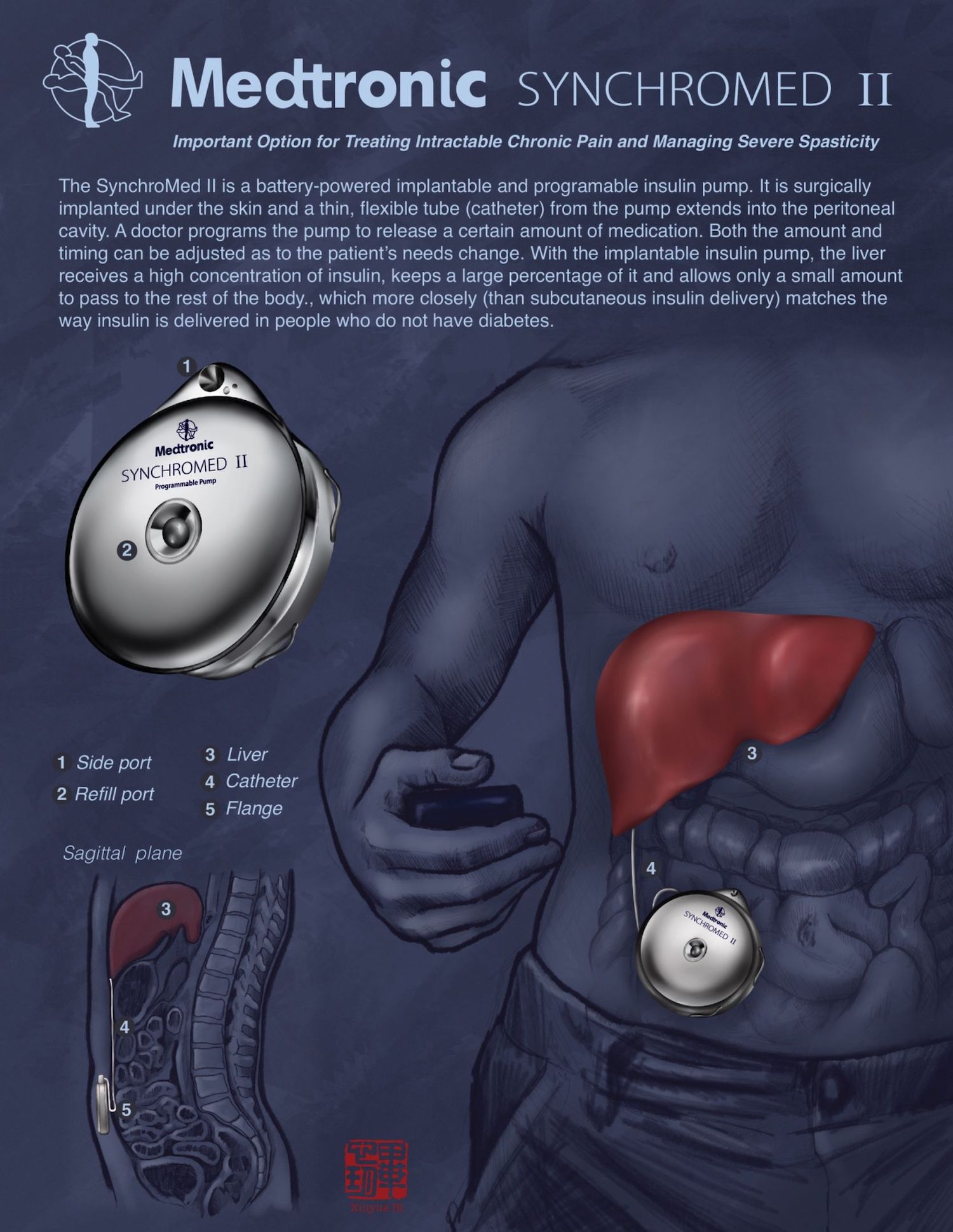 Insulin Pump Illustration