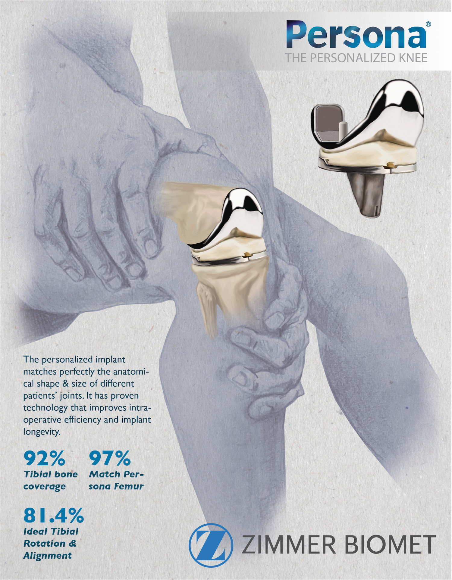 Knee Replacement Illustration