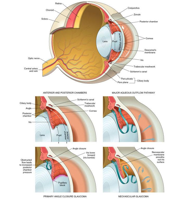 glaucoma eye diagram