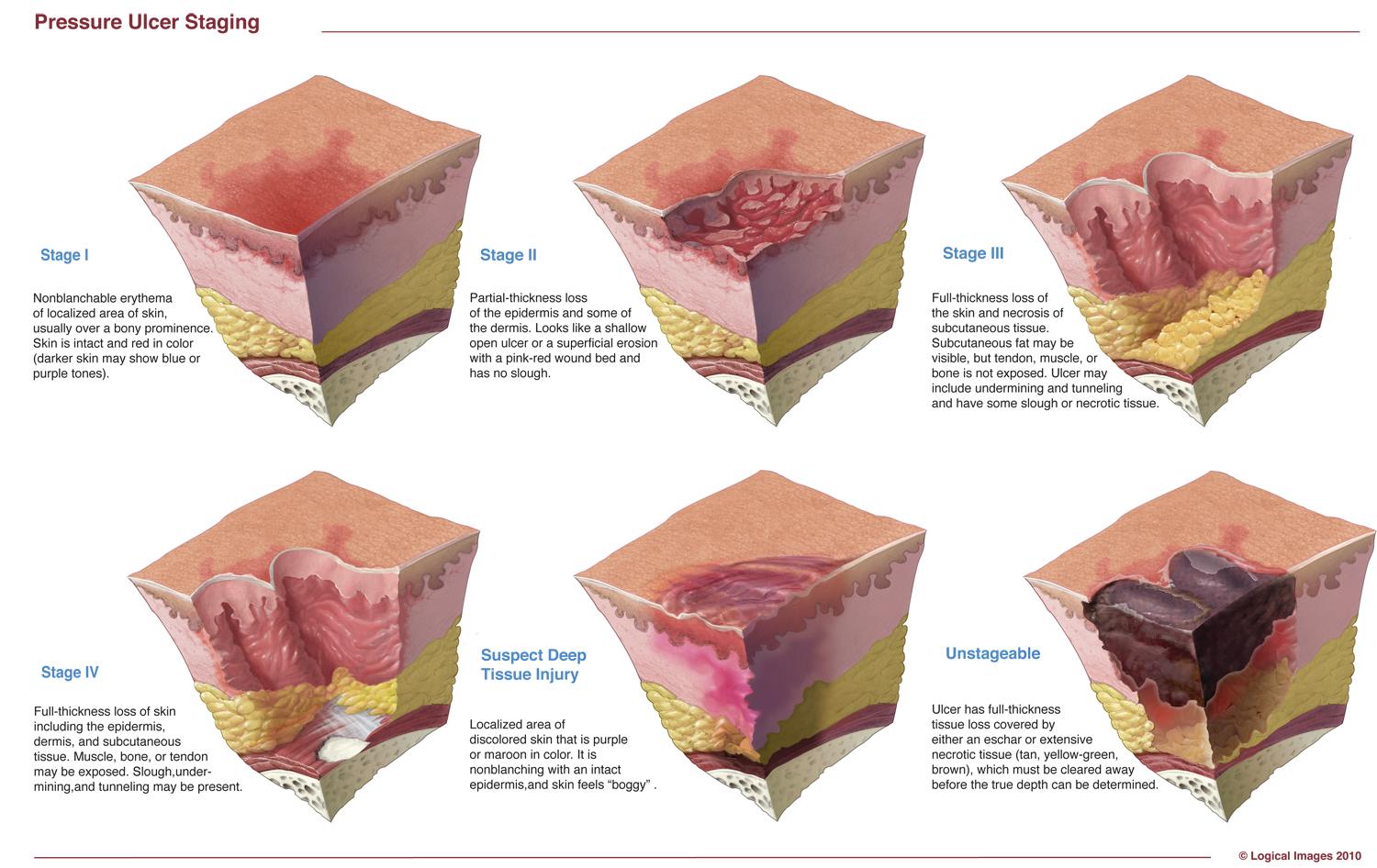 Staging Pressure Ulcers Rit