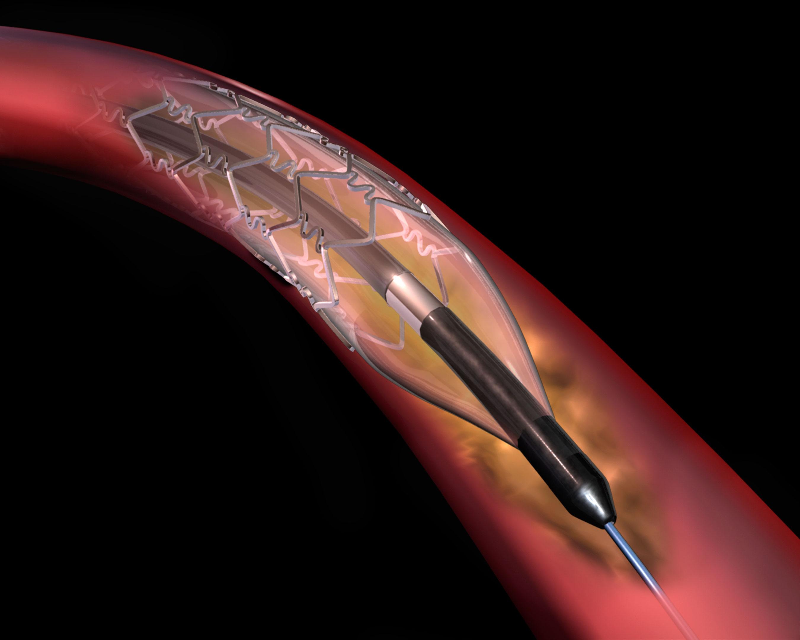 An illustration of a stent in the body.